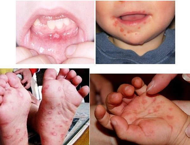 Những thông tin bạn cần biết về bệnh chân tay miệng của trẻ